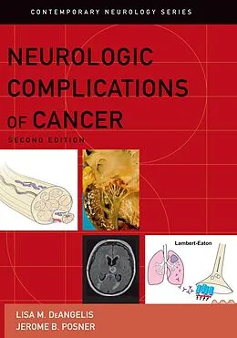 E-Book (pdf) Neurologic Complications of Cancer von Lisa M Deangelis, Jerome B Posner
