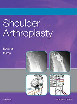 E-Book (epub) Shoulder Arthroplasty E-Book von T. Bradley Edwards MD, Brent J. Morris MD