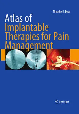 E-Book (pdf) Atlas of Implantable Therapies for Pain Management von Timothy R Deer