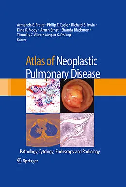 E-Book (pdf) Atlas of Neoplastic Pulmonary Disease von Armando E. Fraire, Philip T. Cagle, Richard S. Irwin