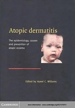 E-Book (pdf) Atopic Dermatitis von Williams