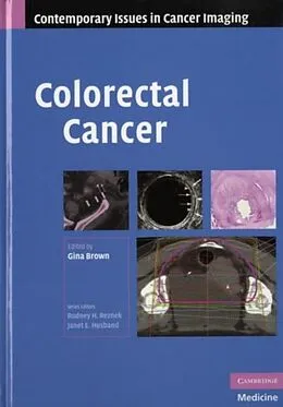 E-Book (pdf) Colorectal Cancer von Brown