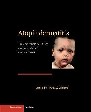 Atopic Dermatitis