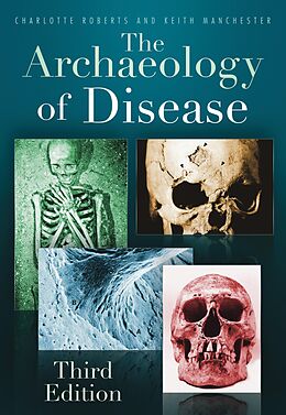 eBook (epub) The Archaeology of Disease de Charlotte Roberts, Keith Manchester