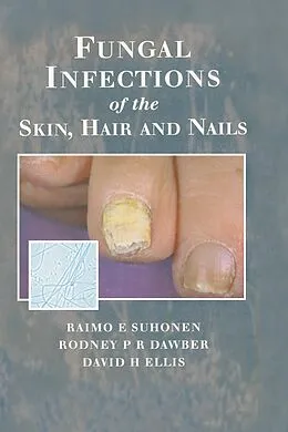 E-Book (pdf) Fungal Infections of the Skin and Nails von Raimo E. Suhonen, Rodney P. R. Dawber, David H. Ellis