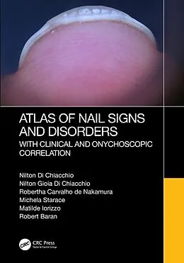 E-Book (pdf) Atlas of Nail Signs and Disorders with Clinical and Onychoscopic Correlation von Nilton Di Chiacchio, Nilton Gioia Di Chiacchio, Robertha Carvalho de Nakamura