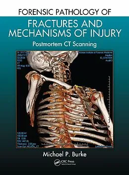 E-Book (epub) Forensic Pathology of Fractures and Mechanisms of Injury von Michael P. Burke