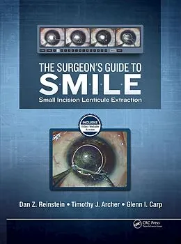 E-Book (pdf) The Surgeon's Guide to SMILE von Dan Reinstein, Timothy Archer, Glenn Carp