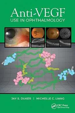E-Book (pdf) Anti-VEGF Use in Ophthalmology von Jay Duker, Michelle Liang