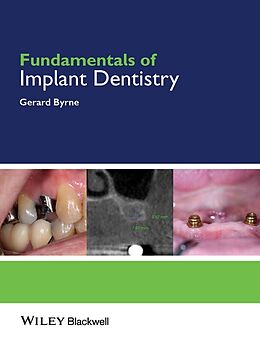 eBook (epub) Fundamentals of Implant Dentistry de Gerard Byrne