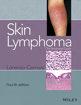 E-Book (pdf) Skin Lymphoma von Lorenzo Cerroni