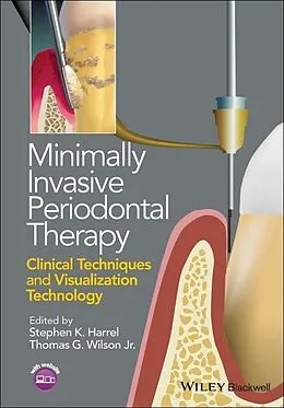 E-Book (pdf) Minimally Invasive Periodontal Therapy von Stephen K. Harrel, Thomas G. Wilson