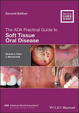 E-Book (pdf) The ADA Practical Guide to Soft Tissue Oral Disease von Michael A. Kahn, J. Michael Hall