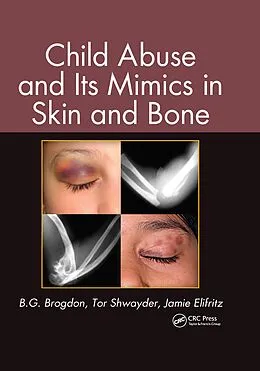 E-Book (pdf) Child Abuse and its Mimics in Skin and Bone von B. G. Brogdon, Tor Shwayder, Jamie Elifritz
