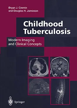 E-Book (pdf) Childhood Tuberculosis: Modern Imaging and Clinical Concepts von Bryan J. Cremin, Douglas H. Jamieson