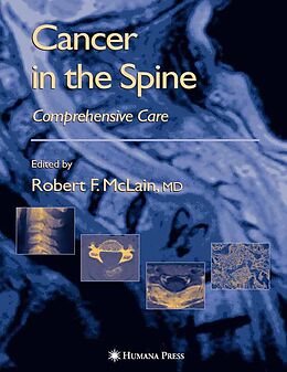 E-Book (pdf) Cancer in the Spine von Maurie Markman, Robert F. McLain, Kai-Uwe Lewandrowski