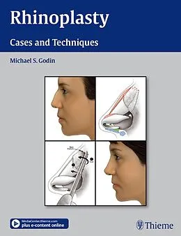 E-Book (pdf) Rhinoplasty von Michael S. Godin
