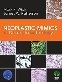 E-Book (epub) Neoplastic Mimics in Dermatopathology von Mark R. Wick, James W. Patterson