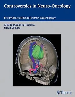 E-Book (epub) Controversies in Neuro-Oncology von 