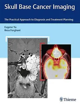 E-Book (epub) Skull Base Cancer Imaging von Eugene Yu, Reza Forghani