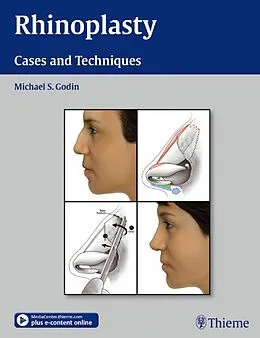 E-Book (epub) Rhinoplasty von Michael S. Godin
