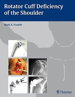 E-Book (epub) Rotator Cuff Deficiency of the Shoulder von 