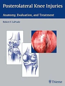 E-Book (epub) Posterolateral Knee Injuries von Robert F. Laprade