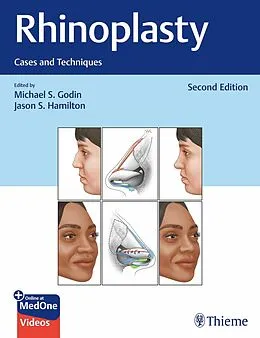 E-Book (epub) Rhinoplasty von Michael S. Godin, Jason S. Hamilton