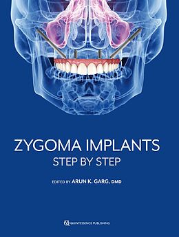 eBook (epub) Zygoma Implants de Arun K. Garg