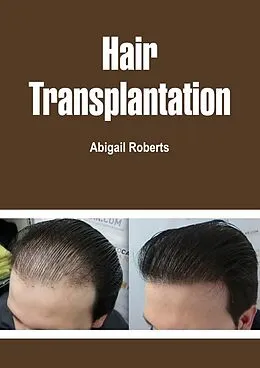 E-Book (epub) Hair Transplantation von Abigail Roberts