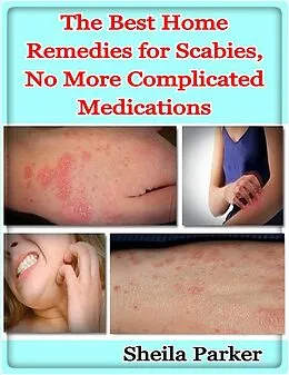 E-Book (epub) The Best Home Remedies for Scabies, No More Complicated Medications von Sheila Parker