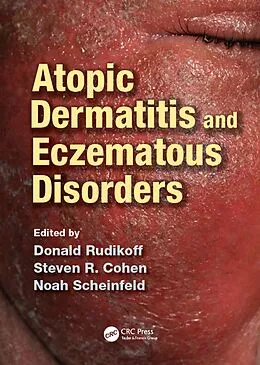 E-Book (pdf) Atopic Dermatitis and Eczematous Disorders von Donald Rudikoff, Steven R Cohen, Noah Scheinfeld