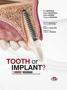E-Book (epub) Tooth or Implant? von Pio Bertani, Paolo Generali, Fabio Gorni
