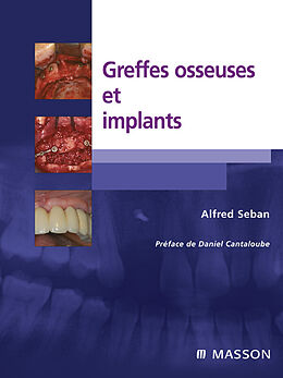 eBook (pdf) Greffes osseuses et implants de Alfred Seban