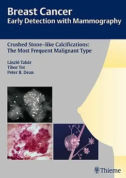 E-Book (pdf) Breast Cancer: Early Detection with Mammography von Laszlo Tabar, Tibor Tot, Peter B. Dean