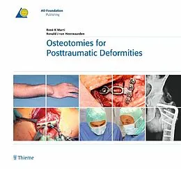 E-Book (pdf) Osteotomies for Posttraumatic Deformities von Ronald J. van Heerwaarden, René K. Marti