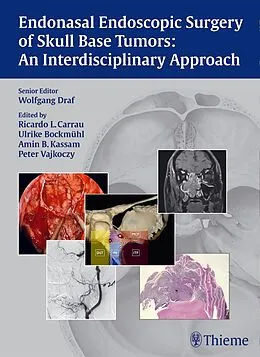 E-Book (pdf) Endonasal Endoscopic Surgery of Skull Base Tumors: An Interdisciplinary Approach von Wolfgang Draf, Ricardo L. Carrau, Ulrike Bockmühl