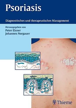 E-Book (pdf) Psoriasis von Peter Elsner, Johannes Norgauer