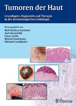 E-Book (pdf) Tumoren der Haut von Rolf-Markus Szeimies, Axel Hauschild, Claus Garbe u. a.