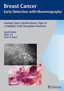 E-Book (pdf) Breast Cancer: Early Detection with Mammography von Laszlo Tabar, Tibor Tot, Peter B. Dean