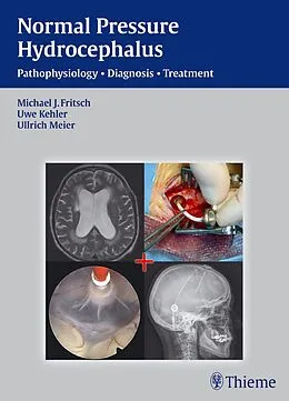 E-Book (pdf) Normal Pressure Hydrocephalus von Michael J. Fritsch, Ullrich Meier, Uwe Kehler