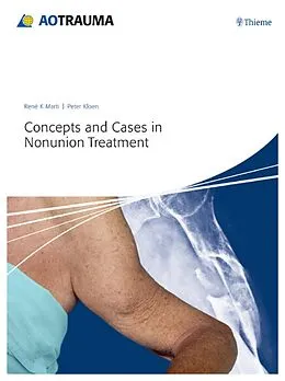 E-Book (pdf) Concepts and Cases in Nonunion Treatment von Peter Kloen, René K. Marti