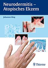 E-Book (pdf) Neurodermitis - Atopisches Ekzem von Johannes Ring