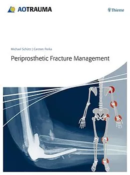 E-Book (pdf) Periprosthetic Fracture Management von Michael Schütz, Carsten Perka