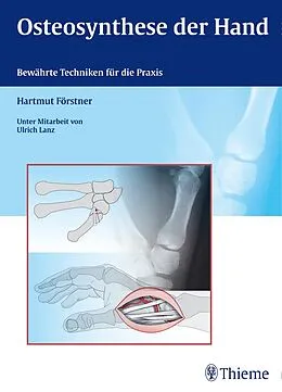 E-Book (epub) Osteosynthese der Hand von Hartmut Förstner