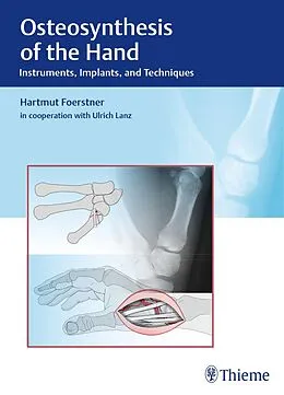 E-Book (pdf) Osteosynthesis of the Hand von Hartmut Förstner