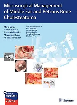 E-Book (epub) Microsurgical Management of Middle Ear and Petrous Bone Cholesteatoma von Mario Sanna, Hiroshi Sunose, Fernando Mancini