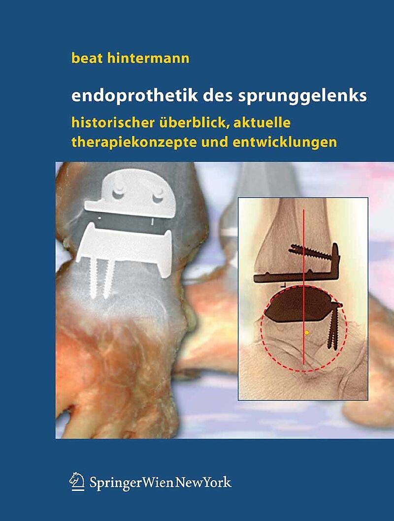 Endoprothetik des Sprunggelenks