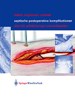 Fester Einband Septische postoperative Komplikationen von Matthias Bühler, Martin Engelhardt, Hergo G.K. Schmidt