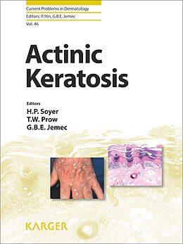 eBook (pdf) Actinic Keratosis de 